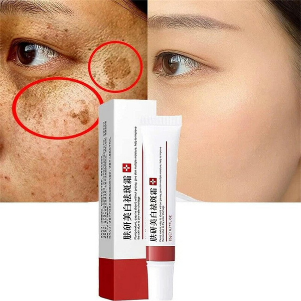 Gonice 2pcs Whitening Freckle Cream, Acne Scar Removal Treatment Cream